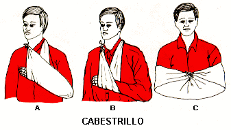 cabestrillo