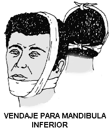 vendaje mandibula